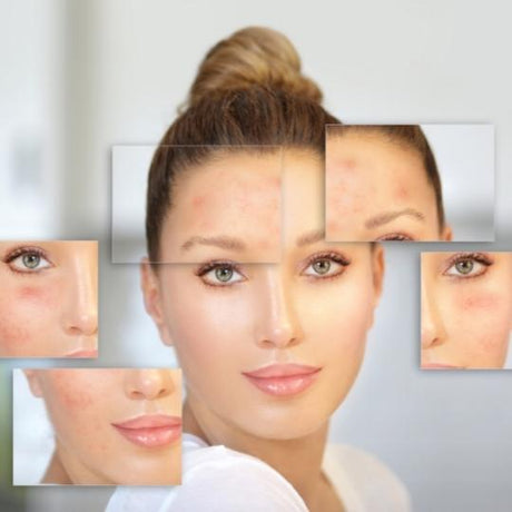 Acne Care