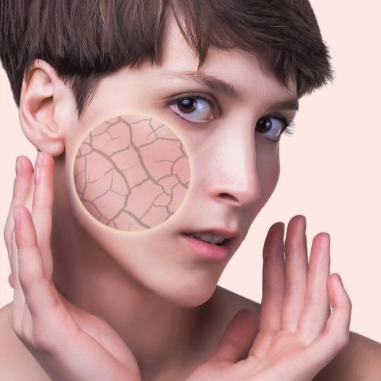 Dry Skin